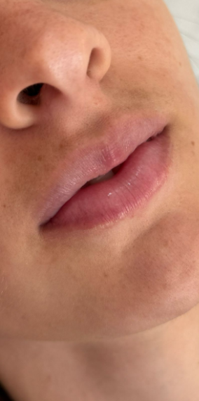 Antes da harmonização